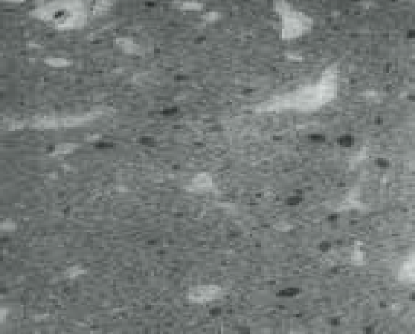 Handmischung Knochenzement - ungleichmäßige Mischung im Vergleich