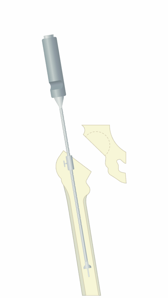 Grafische Darstellung des Zementstoppers im Einsatz – Spülen, Größenbestimmung mit Probeolive, Setzen des Plugs und Setzen der Prothese