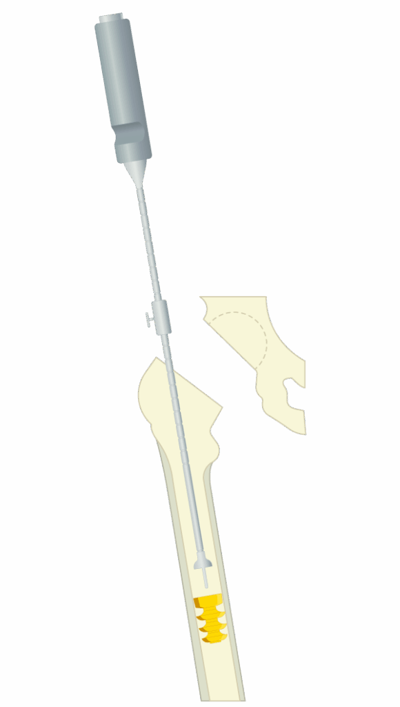 Grafische Darstellung des Zementstoppers im Einsatz – Spülen, Größenbestimmung mit Probeolive, Setzen des Plugs und Setzen der Prothese