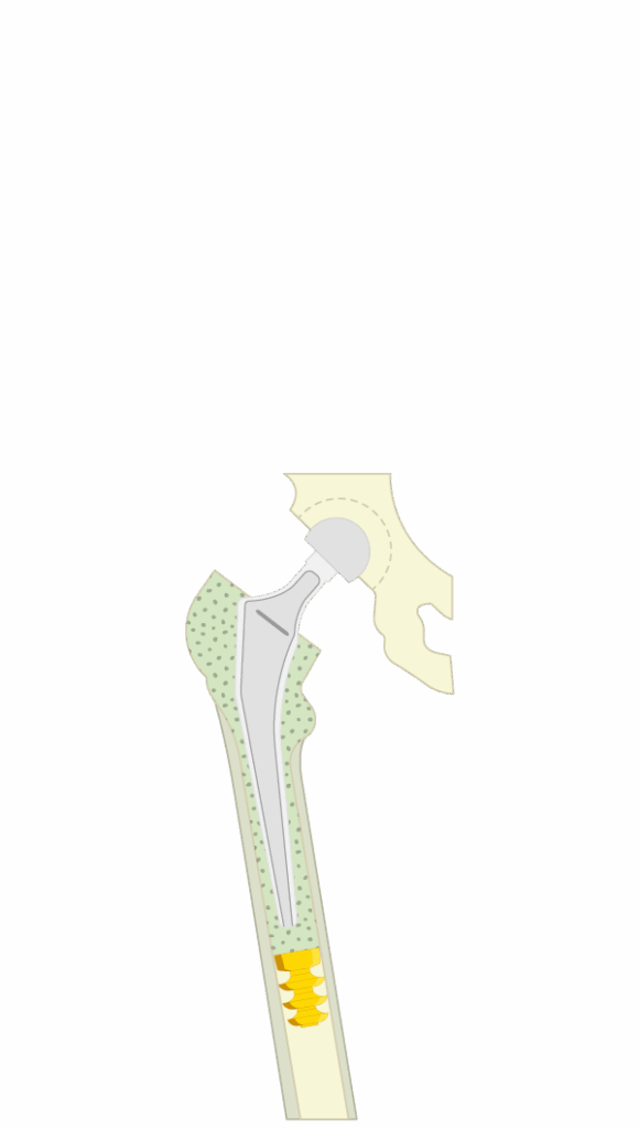 Grafische Darstellung des Zementstoppers im Einsatz – Spülen, Größenbestimmung mit Probeolive, Setzen des Plugs und Setzen der Prothese
