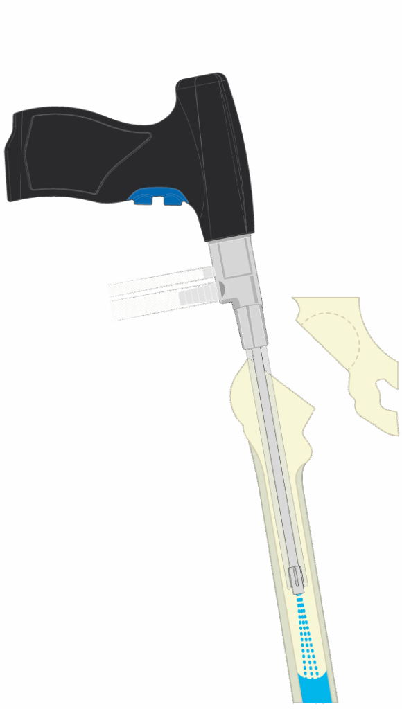 Grafische Darstellung des Zementstoppers im Einsatz – Spülen, Größenbestimmung mit Probeolive, Setzen des Plugs und Setzen der Prothese